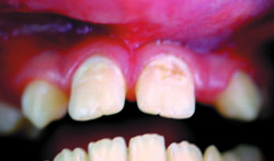 Кариес вестибулярной поверхности 11 и 21 зубов и дистальной поверхности 11 зуба у ребенка 12 лет 