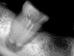 Рентгеновский снимок 47-го зуба. Хронический гранулематозный периодонтит