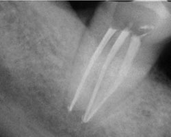 Рентгеновский снимок 47-го зуба через 6 месяцев после ФАД