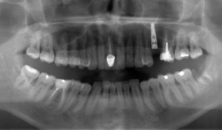 Замена имплантом зуба