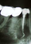 Рентегнограмма 44 зуба вместе с гуттаперчей