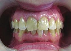 Вид зубов после композитного лечения