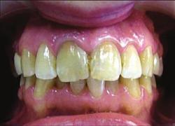 Нарушение краевого прилегания реставрация на зубах
