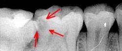 Контактный кариес скрывается между зубов