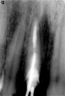Рентгеновский снимок сколотого зуба