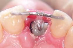 Тяга, которая и вытягивает зуб из десны