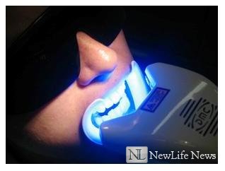 Отбеливание зубов с помощью лазера.