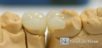Инновационное лечение зубов с помощью вкладок.