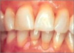Агрессивные факторы, влияющие на зубы.