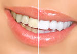 Что необходимо знать об отбеливании зубов