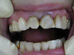 Кариес передних зубов у десны