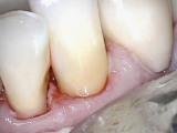 Кариес переднего нижнего зуба