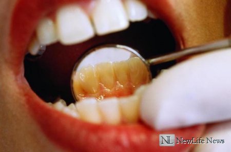Кариес между зубами. Лечение