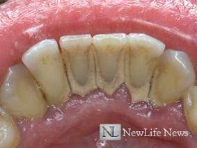 Зубной налет и как от него избавиться