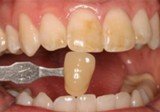 Отбеливание зубов методы