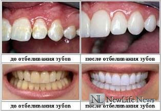 Отбеливание зубов - эффект