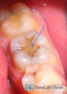 Зубная боль под пломбой