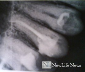 Зубная боль после удаления нерва 