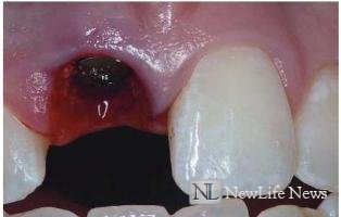 Зубная боль после удаления зуба