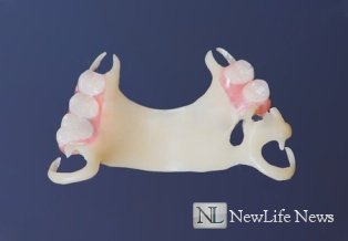 Cъемные частичные зубные протезы