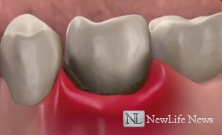 Воспаление десны вокруг зуба
