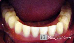 Съемные зубные протезы привыкание