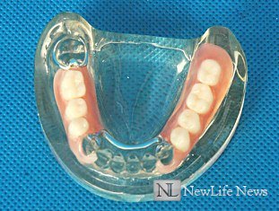 Нейлоновые зубные протезы, недостатки