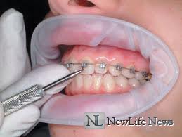 Если беспокоят зубы после установки или снятия брекетов.