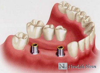 Имплантация и протезирование зубов, в чем разница?