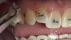 Установка брекетов на зубы при исправлении прикуса