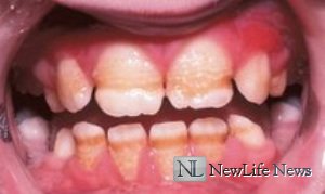 Какие бывают заболевания зубов?