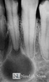 Диагностика и лечение кисты зуба 
