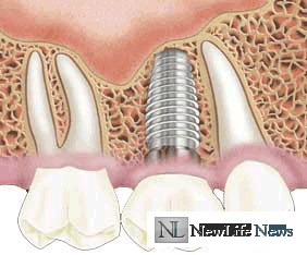 Мифы об имплантации зубов