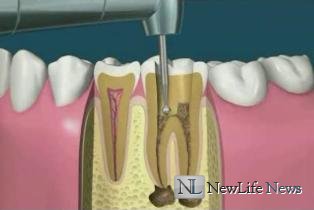 Лечение корней зуба 