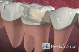 Восстановление зуба на штифте