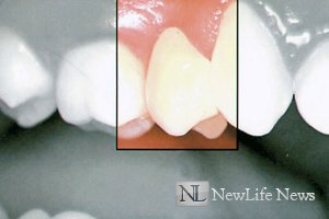Протезирование зубов без обточки