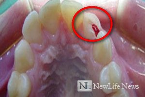 Восстановление сломанного зуба