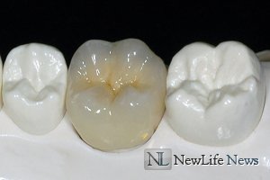 Протезирование 1 зуба