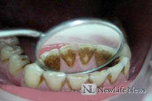 Причины образования зубного камня