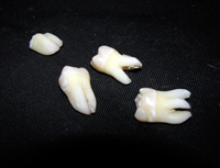 Сколько корней у коренного зуба?