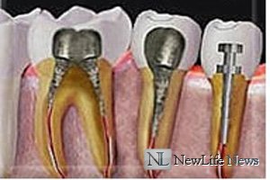 Восстановление корня зуба
