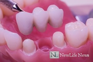 Подготовка зубов к протезированию